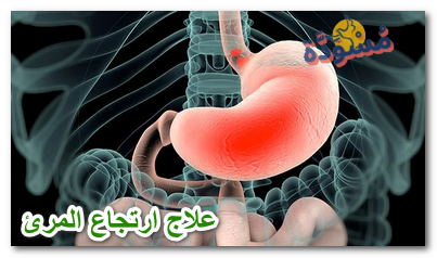 علاج ارتجاع المرئ